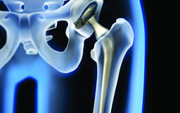 Joint Replacement