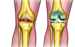 Joint Replacement