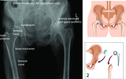 Joint Replacement